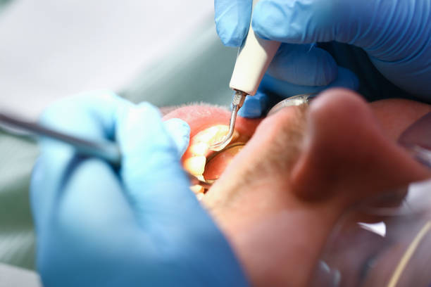 Best Emergency Tooth Extraction in Elburn, IL